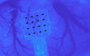 Graphene-based Neurological Implant